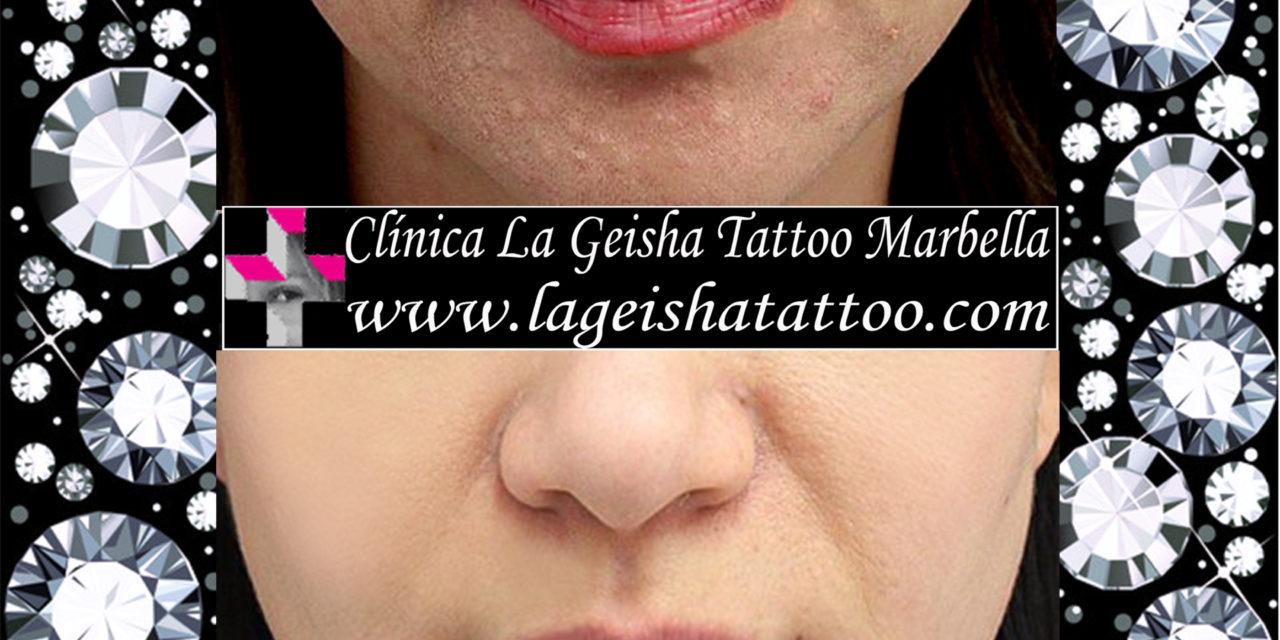 Increible Eliminacin De Micropigmentacin Labial Y Manchas Clnica